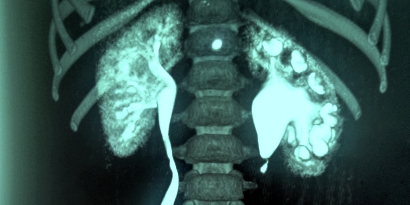 Cirugía robótica para reparación de estenosis UP(Ureteropiélica).