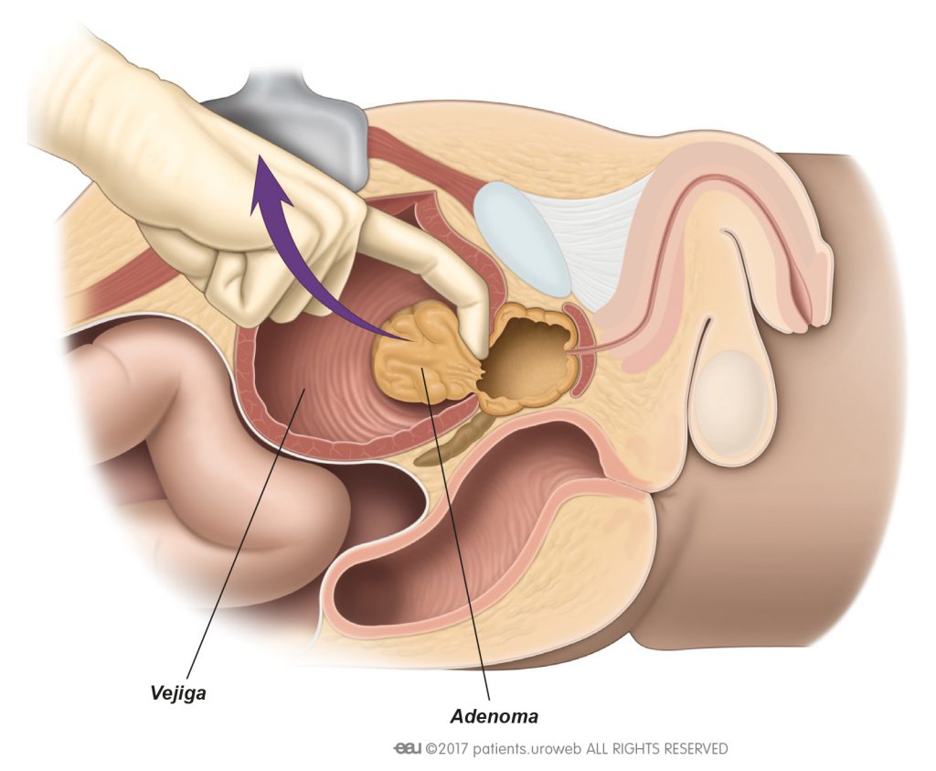 (Prostatectomía abierta) Cirugía abierta para la Próstata