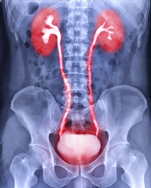 SI Bladder Cancer - Intravenous Pyelogram IVP