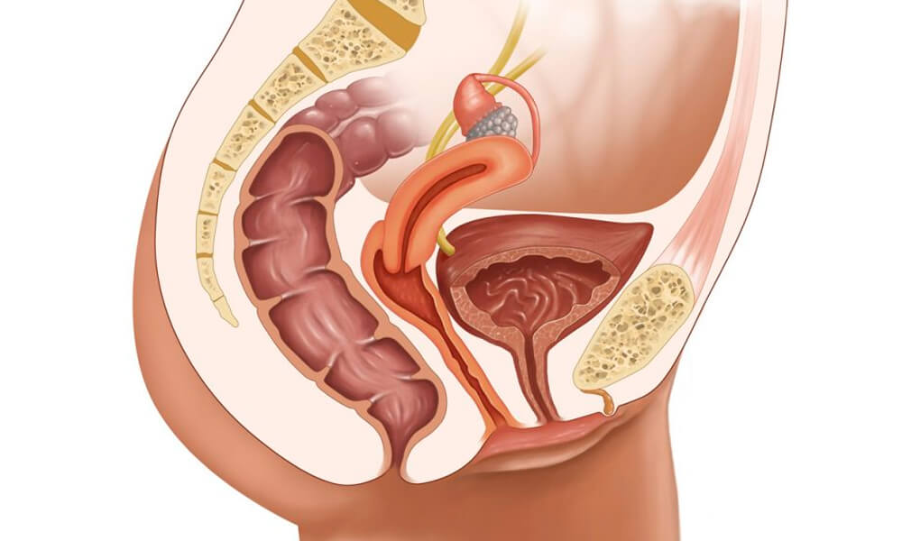 imagenes-para-hero-Fistulas-vesico-vaginales