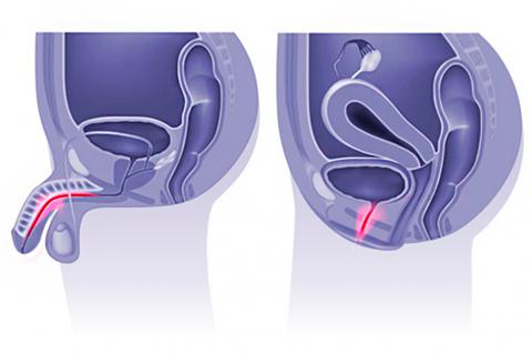uretritis_1